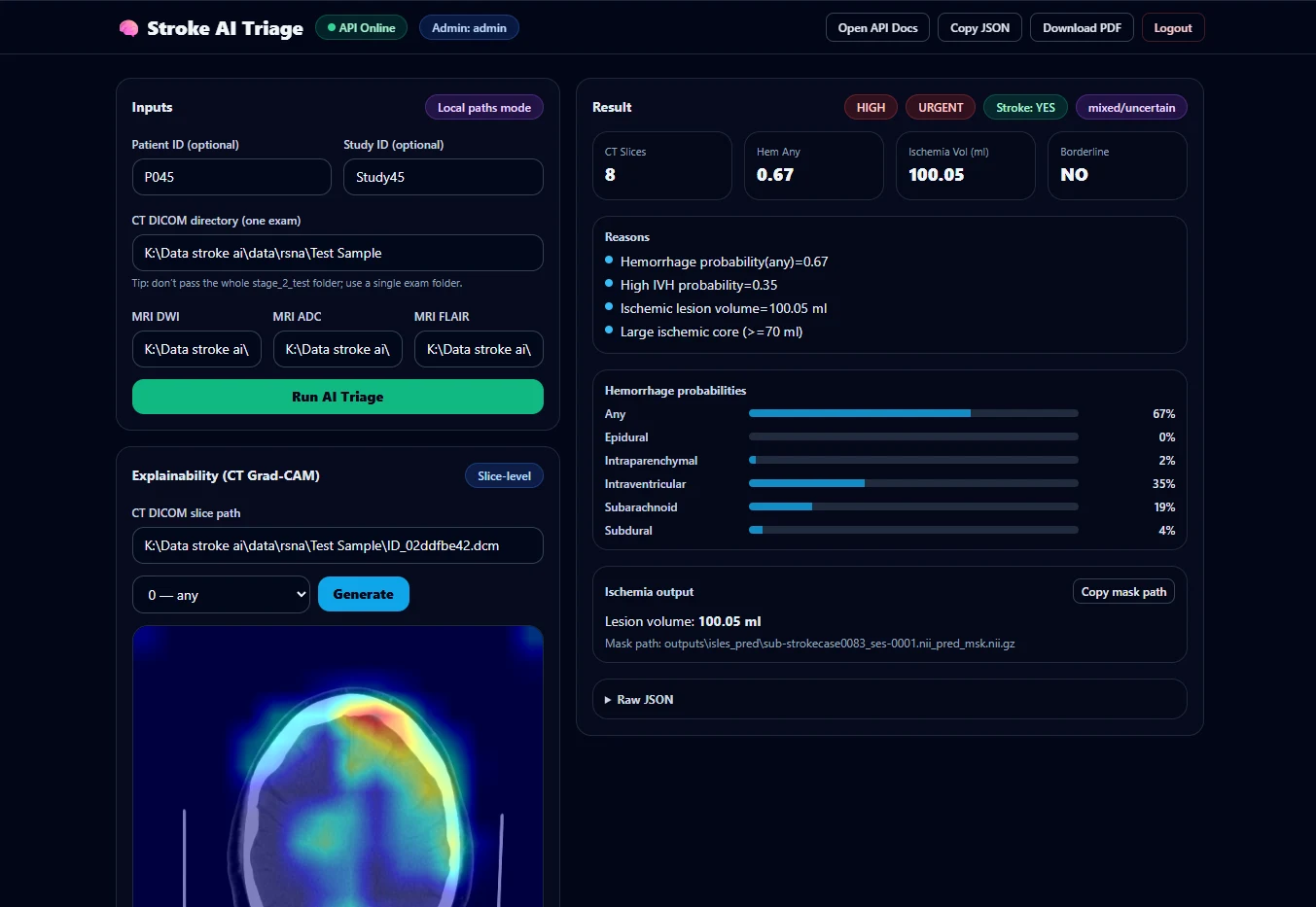 The Stroke AI Triage dashboard after a run: inputs on the left, and on the right the result badges HIGH, URGENT, Stroke YES and mixed or uncertain, the reasons list, haemorrhage probability bars and the ischaemia output of 100.05 ml.