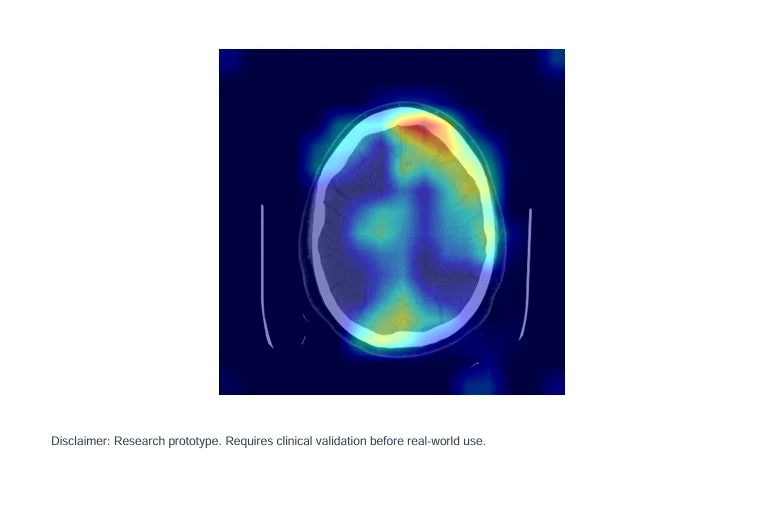 A Grad-CAM heatmap over an axial CT slice of a brain, hottest where the model found evidence of bleeding.